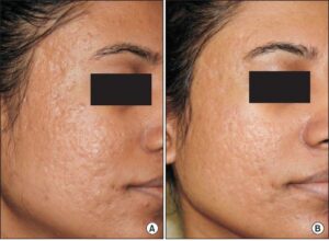 The Efficacy of Bipolar RF Treatment with Microneedles for Acne