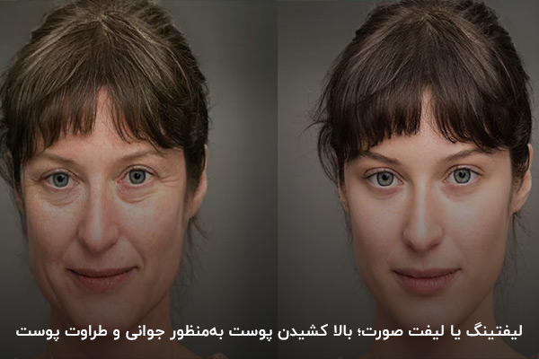 لیفتینگ یا لیفت صورت؛ بالا کشیدن پوست به‌منظور جوانی و طراوت پوست