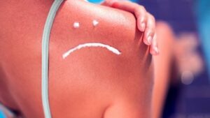 درمان آفتاب سوختگی و تیرگی پوست