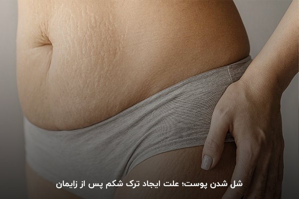 شل شدن پوست؛ یکی از دلایل بروز ترک شکم بعد از زایمان