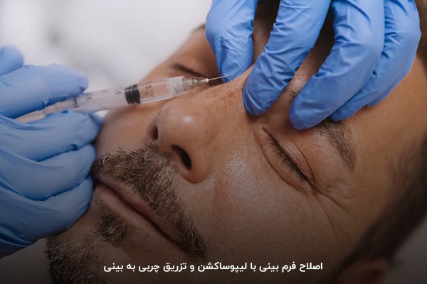 لیپوساکشن و تزریق چربی به بینی؛ کم‌تهاجمی‌ترین عمل برای اصلاح فرم صورت 