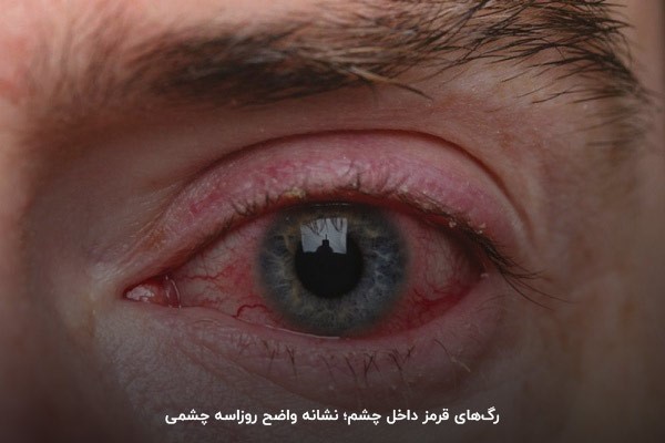 روزاسه چشمی نوعی از بیماری آکنه است که چشم‌ها را تحت‌تاثیر قرار می‌دهد