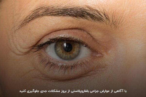 عوارض بلفاروپلاستی با جراحی، مهم‌ترین خطر برای چشم