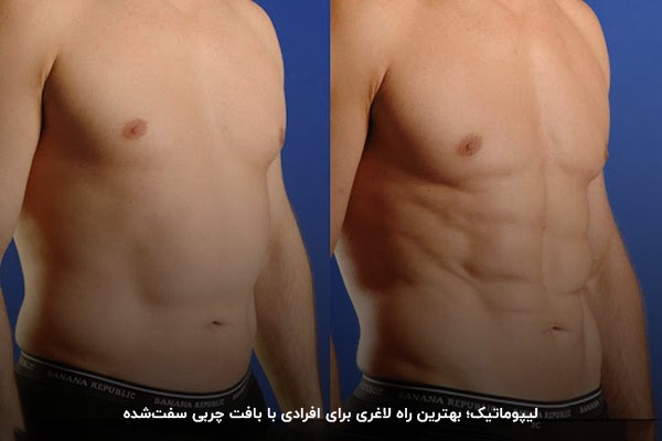 تصویر قبل و بعد عمل لیپوماتیک؛ تاثیر عمل لاغری موضعی با lipomatic