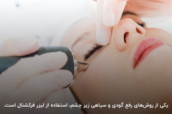 استفاده از لیزر فرکشنال برای رفع گودی و سیاهی زیر چشم