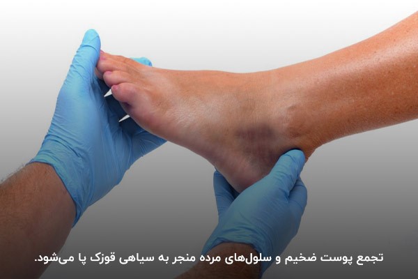سیاهی قوزک پا به دلیل تجمع پوست ضخیم و سلول‌های مرده پوست