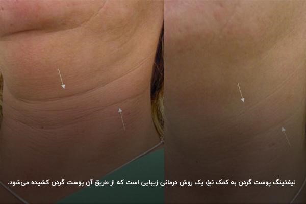 کشیدن پوست با نخ بدون جراحی؛ بهترین روش لیفت گردن