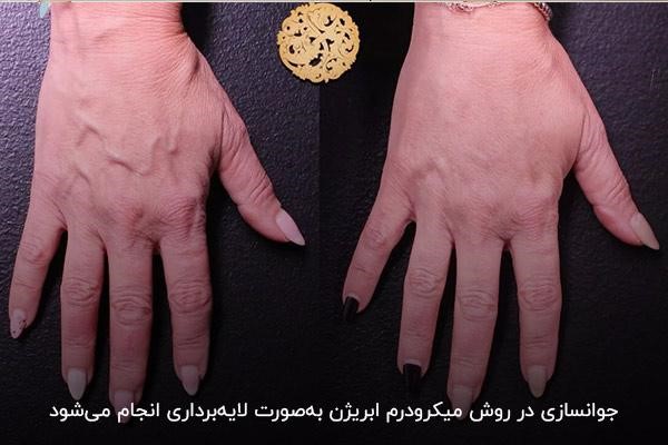 میکرودرم از روش‌های کاربردی برای جوانسازی پوست دست