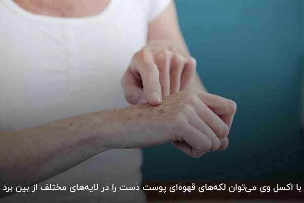 از بین بردن لکه‌های قهوه‌ای پوست دست با دستگاه اکسل وی