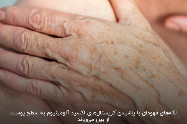 درمان لکه های قهوه ای روی پوست دست بدون عارضه با دستگاه میکرودرم ابریژن