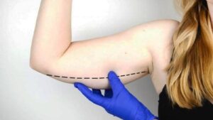 معرفی لیپوماتیک بازو؛ یکی از بهترین روش لاغری موضعی