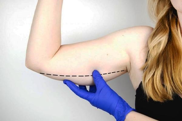 معرفی لیپوماتیک بازو؛ یکی از بهترین روش لاغری موضعی