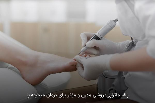 برخورد قوس پلاسما با پوست در روش درمان موثر میخچه پا با پلاسما تراپی