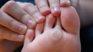 شرح موثرترین روش‌های درمان میخچه پا در وبلاگ آفاطب