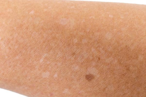بررسی راهکارهای موثر برای رفع لکه‌های سفید روی پوست