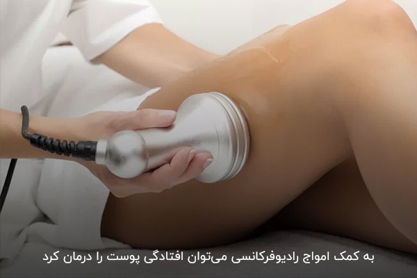 دستگاه آر اف رافوس؛ روشی غیر‌تهاجمی برای رفع افتادگی پوست