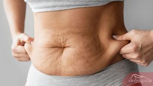 رفع افتادگی پوست بعد از لاغری - آفاطب